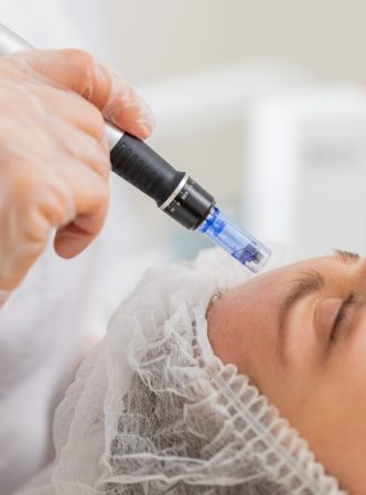 Peeling, woman health care, skin regeneration, dermapen microneedling, dermastamp. Beautician cosmetologist doing forehead face procedure fractional microneedle mesotherapy clinic facial rejuvenation